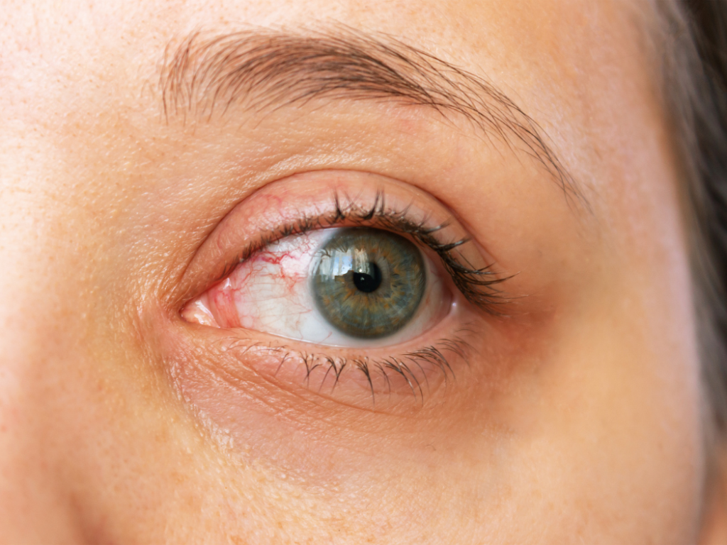 Common allergic Eye symptoms
