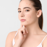 Can Allergies Lead to Acne?: 6 Treatments for Skin Breakouts