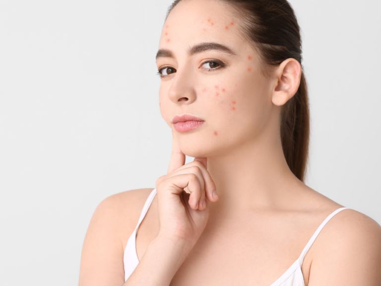 Can Allergies Lead to Acne?: 6 Treatments for Skin Breakouts